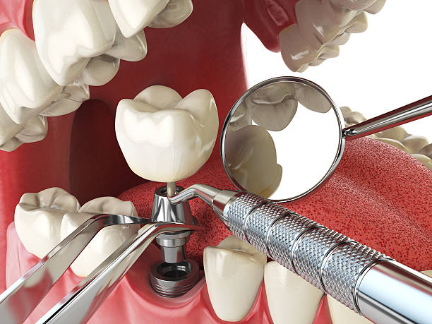 Best Emergency Dentist for Knocked-Out Tooth in Mclendon Chisholm, TX