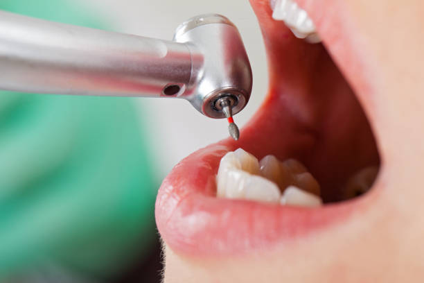 Best Emergency Dental Extractions in Mclendon Chisholm, TX